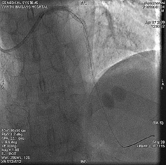 nstemi|【华医大查房】急性NSTEMI处理过程（一）