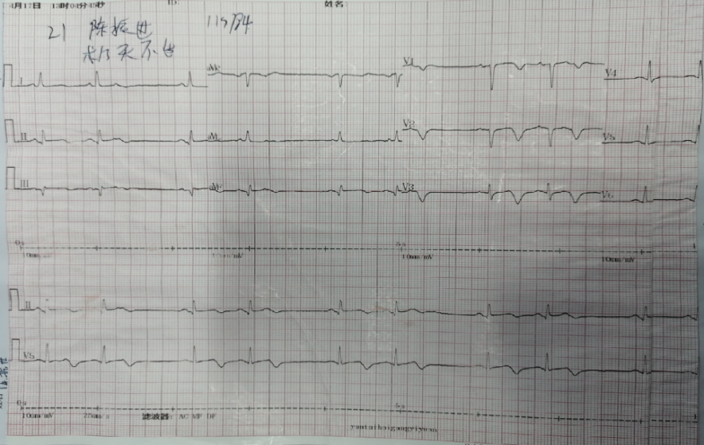 nstemi|【华医大查房】急性NSTEMI处理过程（一）