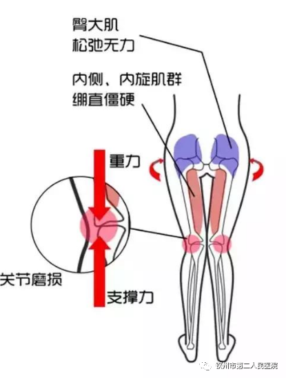 儿童x型腿除了手术还能这样治疗