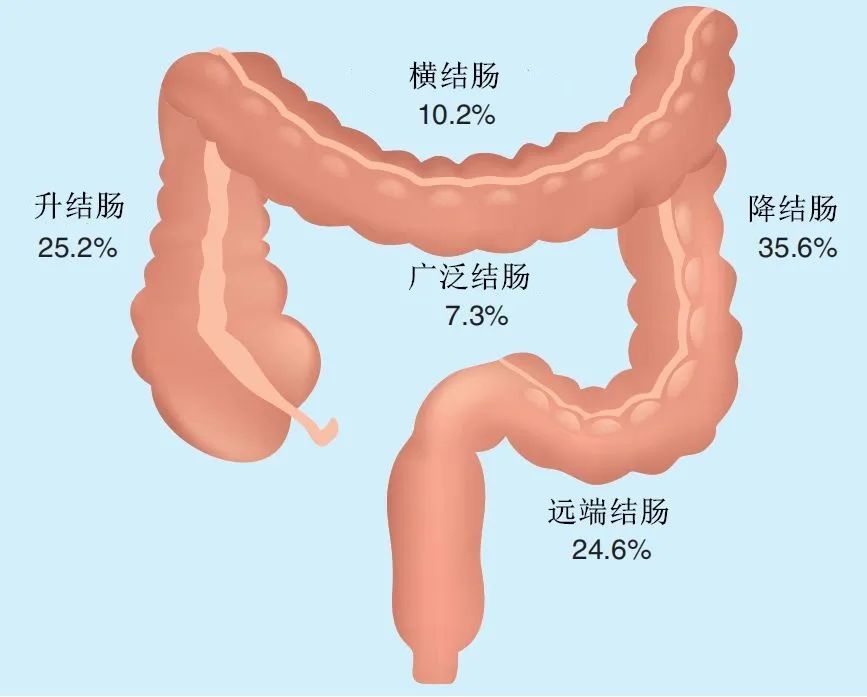 图文并茂 最常见的肠道缺血性疾病 缺血性结肠炎的识别与处理 临床必备 腾讯新闻