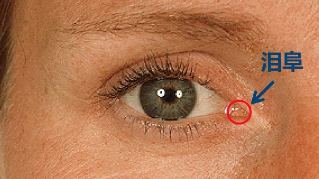 wiki2019年下半年,我明显感觉右眼泪阜变大了一些,而且红红的,正面能