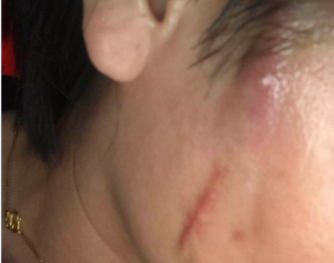 听人说千万不要线雕面部线雕三个月感染了真的是这样嘛