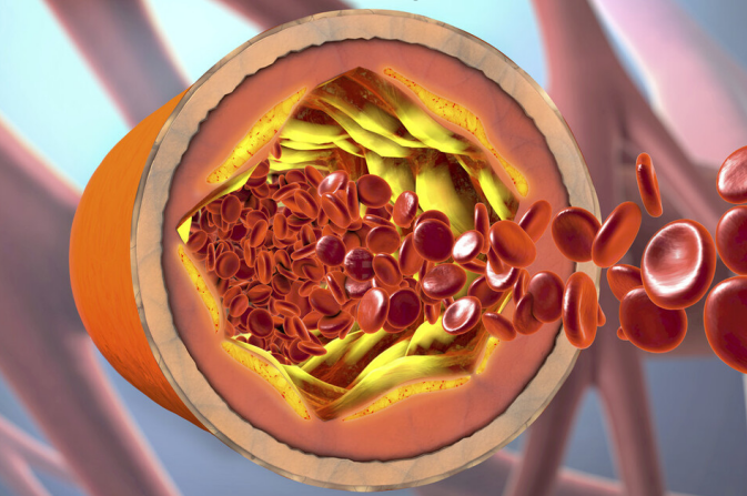 脑梗|一家三口相继脑梗，与烟酒无关，医生：只因炒菜爱放一种“东西”