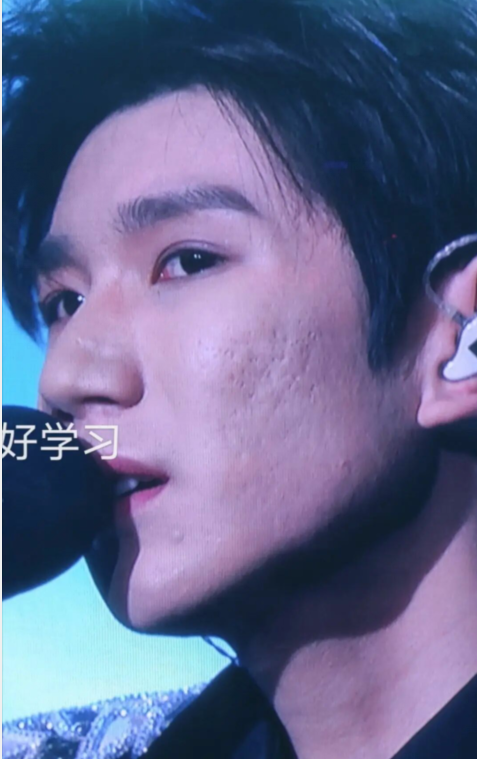 王源近照曝光,满脸痘印似大叔?小鲜肉翻车被嘲颜值下滑