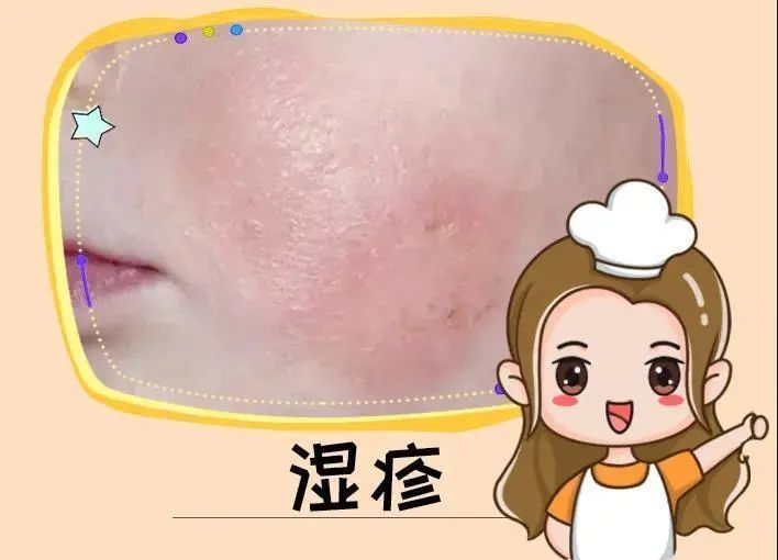 肤康科普湿疹老不好这几个常见的错误生活习惯你有吗小心皮肤顽疾找上