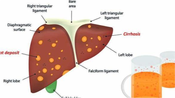 重度脂肪肝還有救嗎主要原因有4個該如何調理