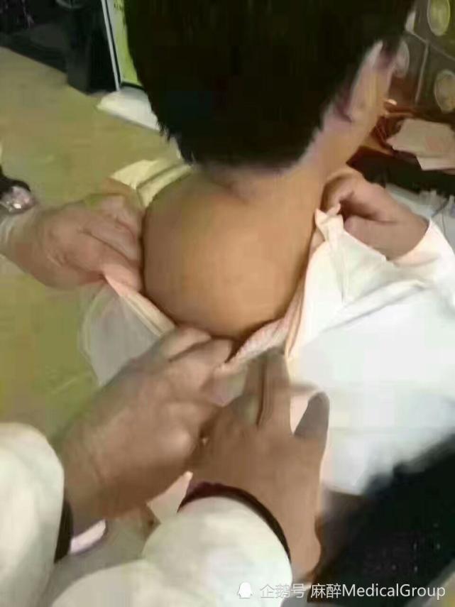 脖子后面的富贵包究竟是怎么回事?