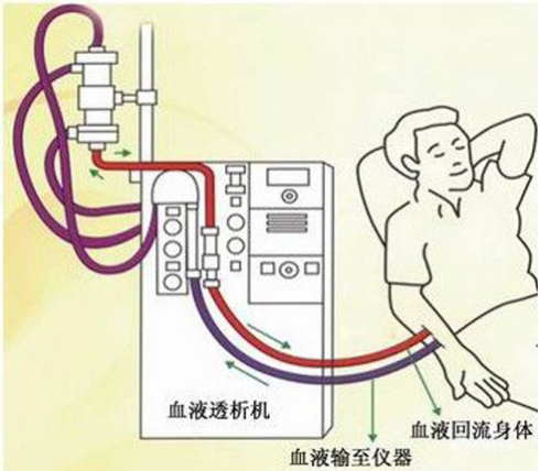 尿毒症|孩子吃汉堡引发尿毒症！“汉堡病”为何这么可怕？