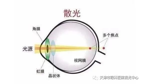 从定义我们可以看出,近视眼与散光眼的成像原理是有所不同的,近视是在