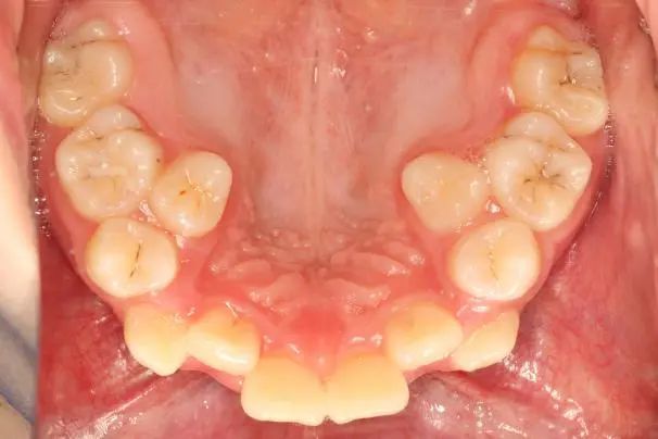 03 恆牙長不整齊,咬合不好 乳牙與恆牙的交替是一個動態平衡過程,所有