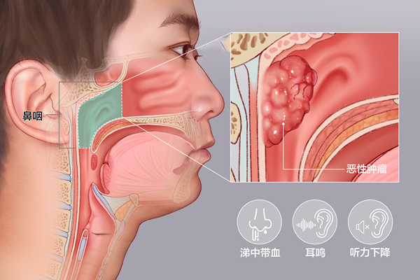 廣藥三院腫瘤一科醫生告訴你很像鼻炎的腫瘤,怎麼區分?_騰訊新聞