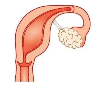 单角子宫怀孕图片