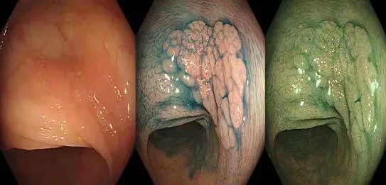 躺着的息肉最危险5类人请善待你的肠道
