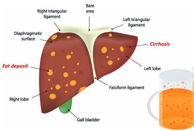 酒精肝|酒精肝发作前，身体多次发出求救信号，爱喝酒的人，及时抓住