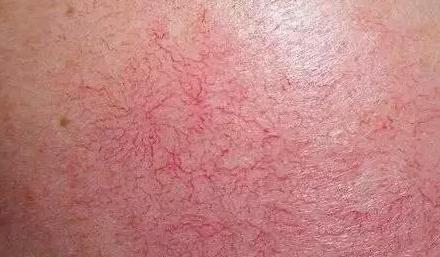 泛红:皮肤表面出现大面积红,皮肤正处于敏感的状态