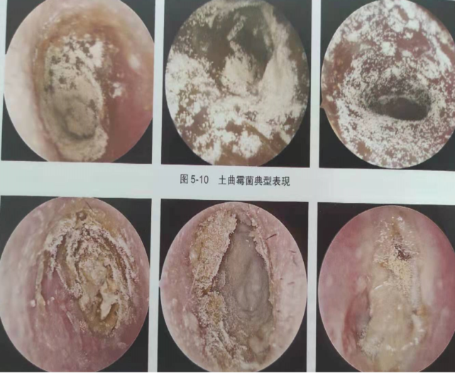 【耳朵癢癢癢!】擅自抓撓有風險