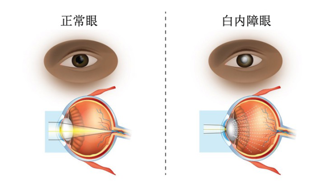 老花眼好轉,也許與白內障有關