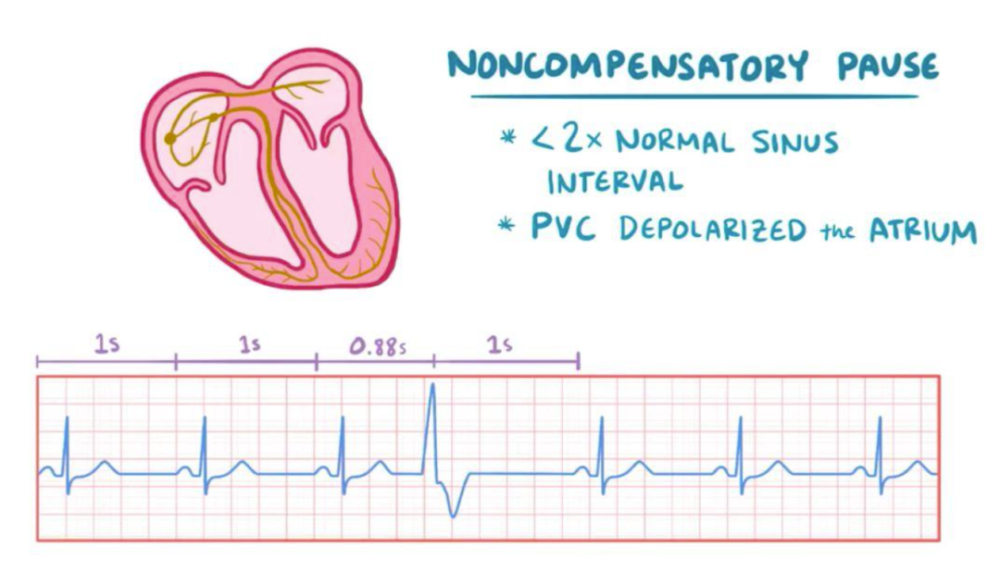 室性早搏熟悉的陌生人