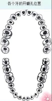 根管治疗的一个重要步骤:开髓术_腾讯网