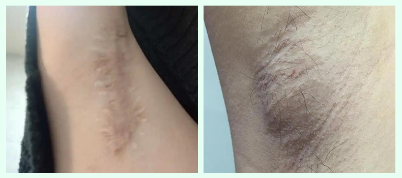 狐臭的"天敌"来了!_腾讯新闻