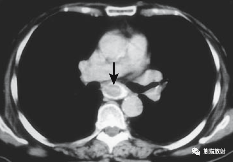 原發性食管惡性黑色素瘤 primary esophageal malignant melanoma食管