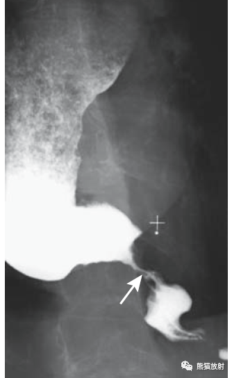 缺乏蠕动(箭头)食管静脉曲张 esophageal varices食管皱褶呈串珠样