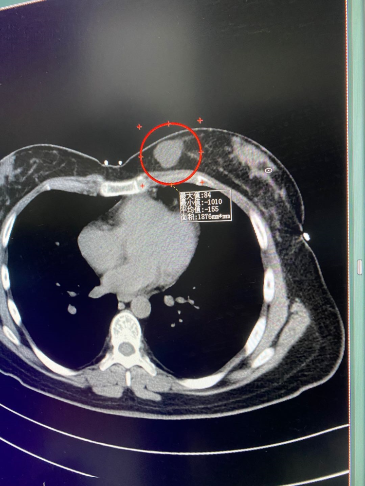 那些年,讀胸部ct片漏過的診