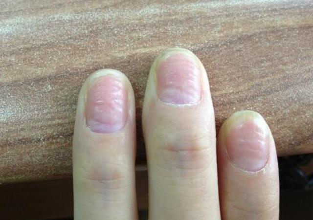 手上若有3个表现,"脑血栓"或已找上你,别犹豫,应及时检查_腾讯新闻