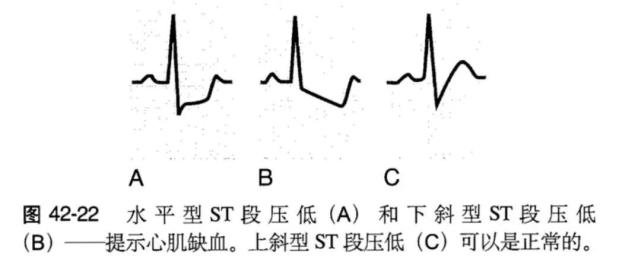 導聯|心臟|心肌缺血|心律失常|心電圖