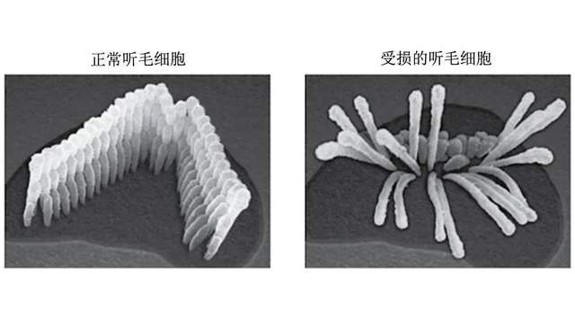 听力损失|这个几乎100％可预防的听力损失，你知道吗？