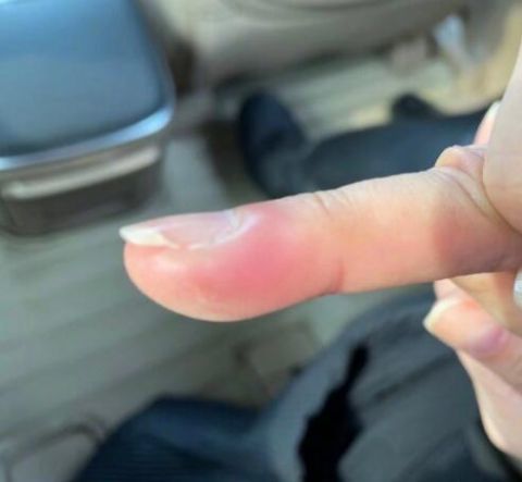 邓萃雯进医院拔倒刺笑侃好像在产房生小孩