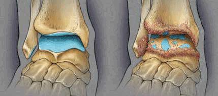 别等踝关节疼痛在后悔|踝关节疼痛|关节|脚踝