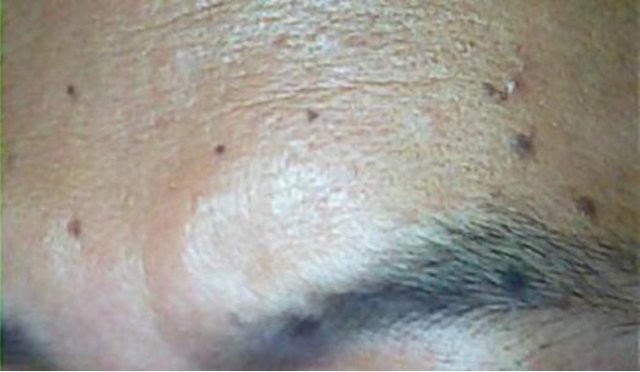 脑梗发出的第1个信号,被很多人当成皮肤病对待,早去医院做下ct_腾讯