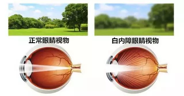 居家自测你有没有得白内障