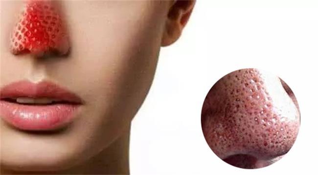 如何拯救草莓鼻?_腾讯新闻
