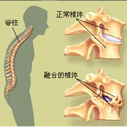 强直真的很痛吗强直有哪些症状呢不知道的一定要看看