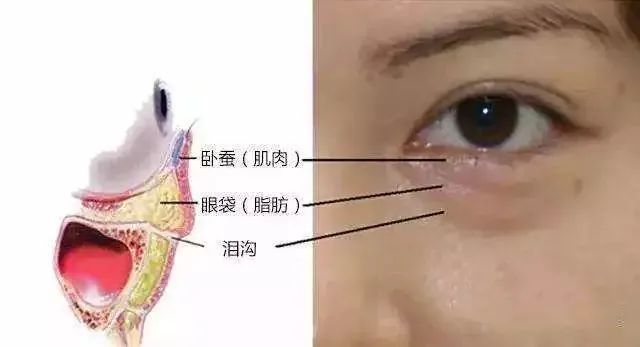 皮肤,眼轮匝肌及眶隔松弛,造成眼部下方脂肪由于重力作用严重脱垂