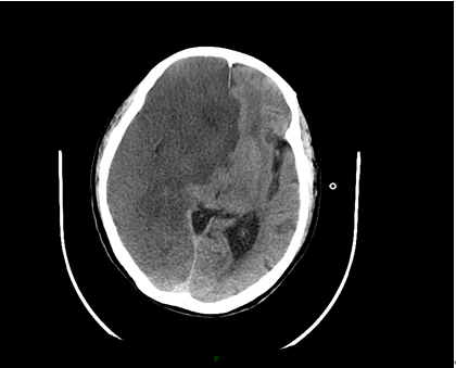 急請神經內科會診診斷大面積腦梗死小腦幕切跡疝右側腦梗塞(圖2),加大