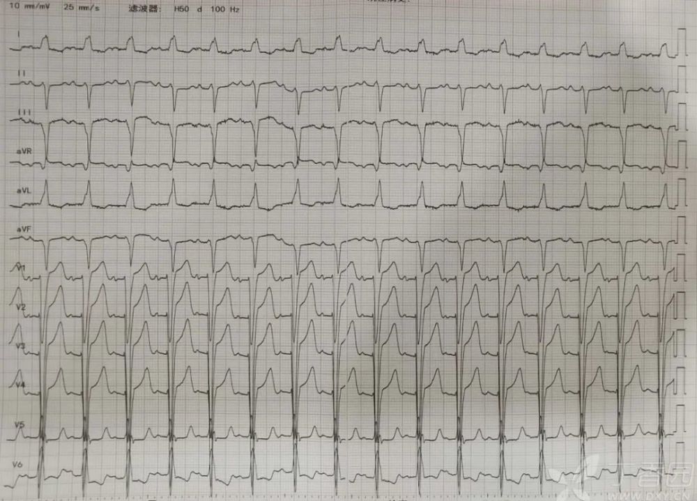 房性心律失常|易误诊的房性心律失常｜达摩心电图专栏
