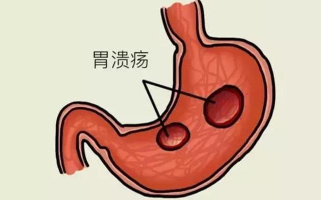 胃病的种类很多,主要包括胃炎,胃炎有包括浅表性胃炎,糜烂性胃炎,萎缩