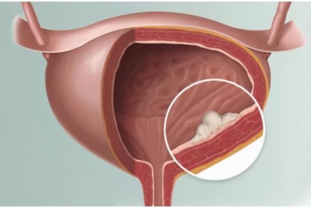 預防膀胱癌注意這兩點