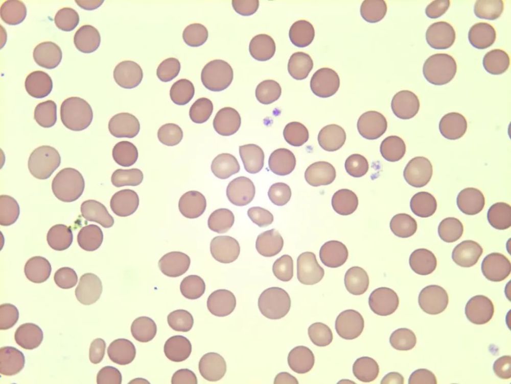 图为球形红细胞增多 提示遗传性球形红细胞增多症等