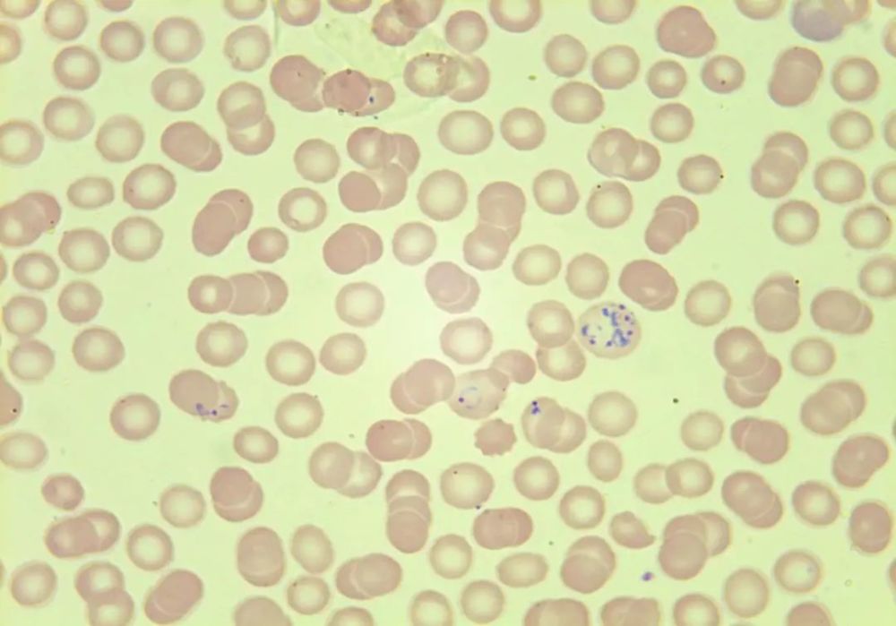 图为疟原虫环状体,滋养体 提示疟疾   part 白细胞形态给我们的反馈