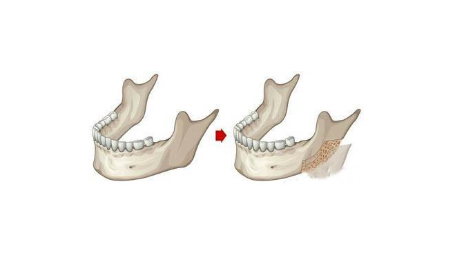 大脸变小脸,做下颌角选削骨术还是磨骨?_腾讯新闻
