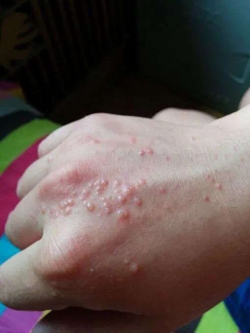 手部湿疹 你是否也有这样的社交障碍手 腾讯新闻