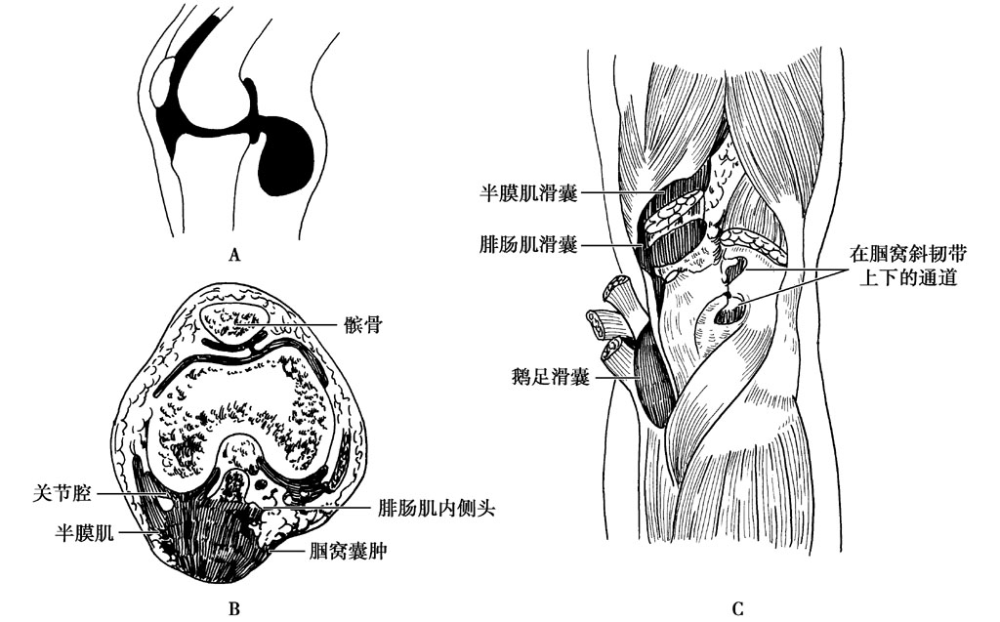 這5種膝關節慢性勞損疾病該如何診治?_騰訊新聞