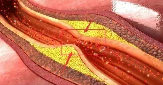 颈动脉有了斑块,对哪里影响最大?有了斑块后需要注意什么?