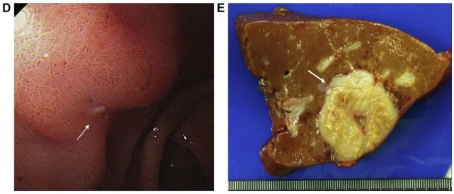 这例患者出现肝结节的原因是……|病例分享_腾讯新闻