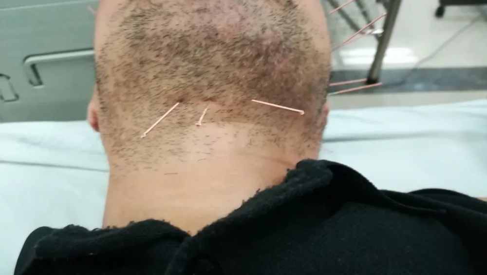 中风后吞咽困难只知道舌三针和点刺舌头其实另一个部位也很重要