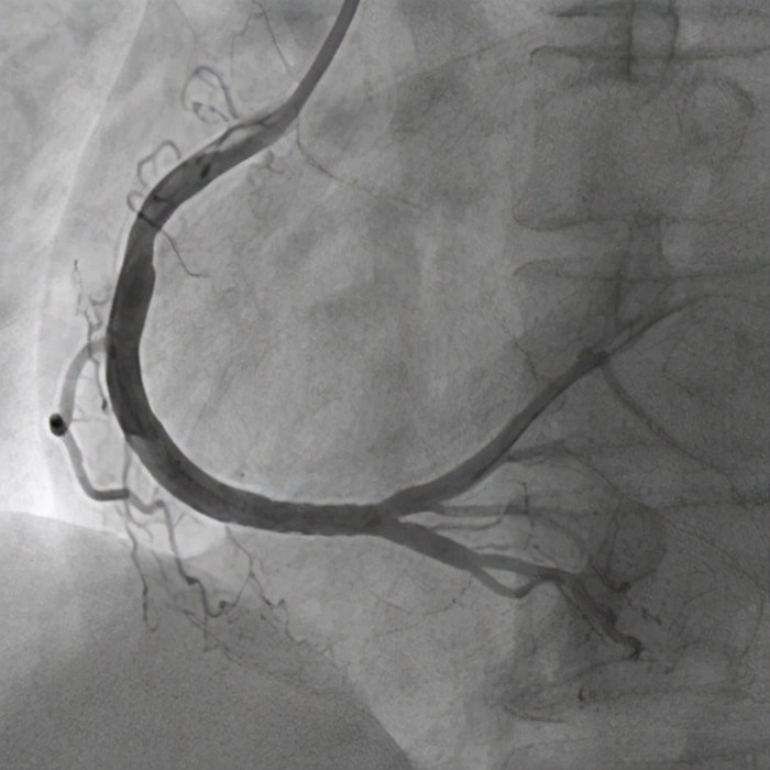 心脏|心脏三个大血管，52岁男子两个血管都丢失，手术台上心脏停跳！